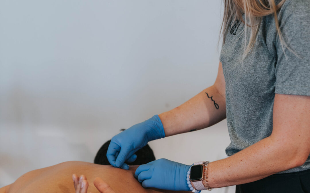 What You Should Know About Dry Needling By A Physical Therapist